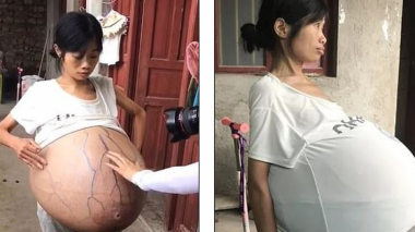 Առեղծվածային հիվանդության հետեւանքով կնոջ որովայնն ահռելի չափերի է հասել. լուսանկարներ