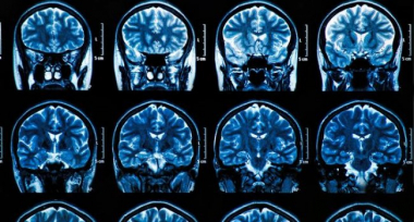 Ասիացիները COVID-19-ի պատճառով 2 անգամ ավելի հաճախ են բախվում կաթվածների․ հետազոտություն