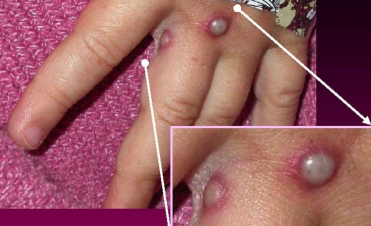 Իսրայելում կապիկի ծաղիկով վարակման առաջին դեպքն է գրանցվել