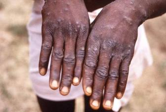 Նիգերիայում գրանցվել է կապիկի ծաղիկից մահվան առաջին դեպքը