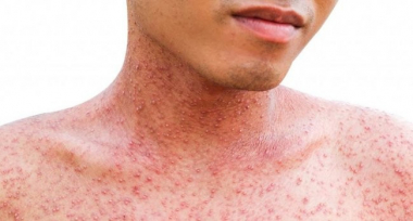 Ժամը 19:00-ի դրությամբ կարմրուկի լաբորատոր հաստատված դեպքերի թիվն աճել է․ հայտնաբերված հիվանդները հոսպիտալացված են