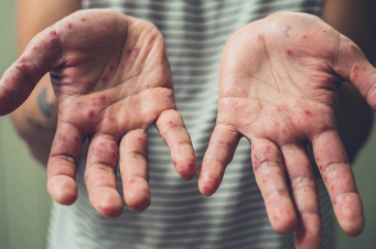 Կարմրուկի լաբորատոր հաստատված դեպքերի թիվը հասել է 39-ի. ԱՆ