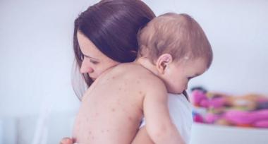 Հայաստանում կարմրուկի լաբորատոր հաստատված դեպքերի թիվը ավելացել է ևս 35-ով