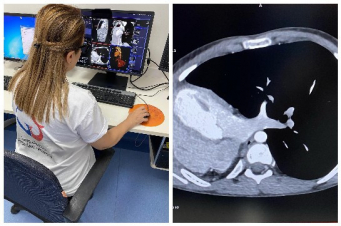 Բացառիկ դեպք` «Նորք-Մարաշ» ԲԿ-ում. պացիենտի սիրտը տեղակայված է կրծքավանդակի աջ կեսում