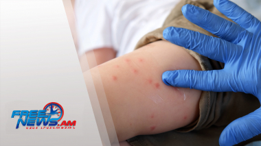 Կարմրուկի դեպքերի նկատելի աճ․ ՀՀ-ն 10-րդն է